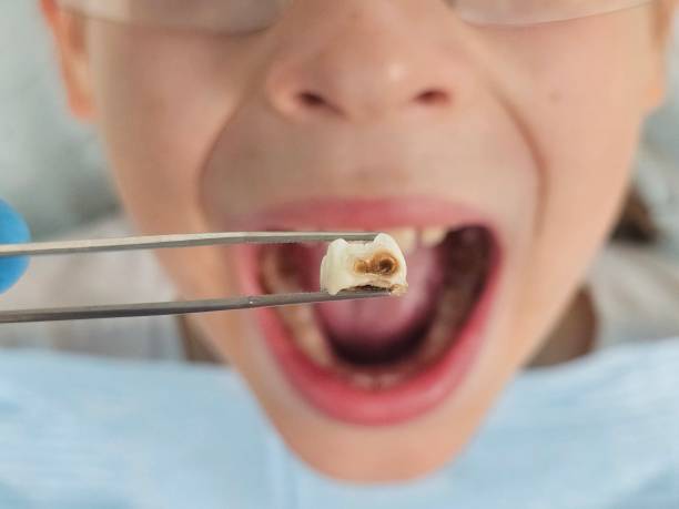 Best Emergency Dental Extractions in Selma, AL
